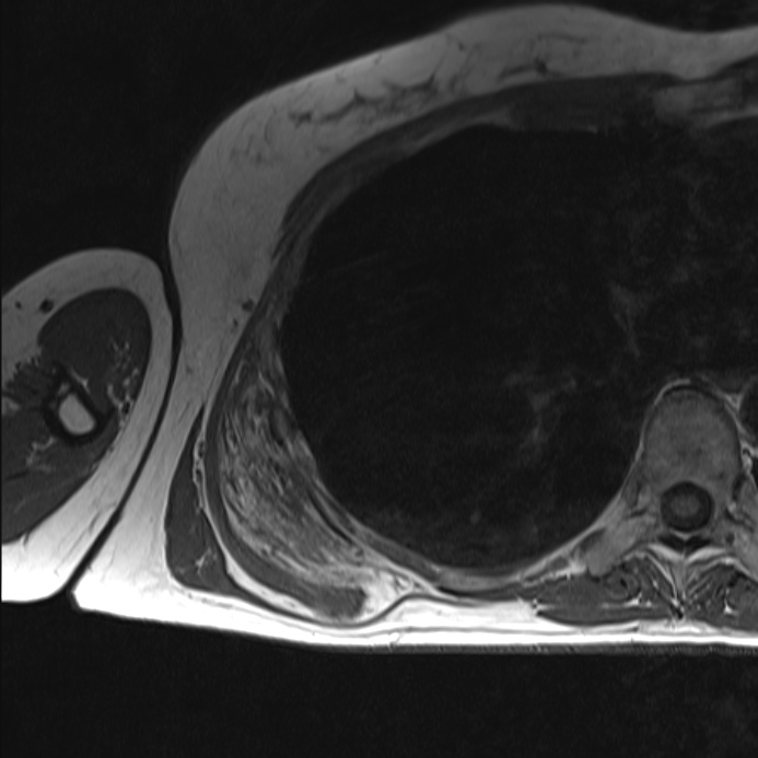 Figure 2 for case Bilateral elastofibroma dorsi